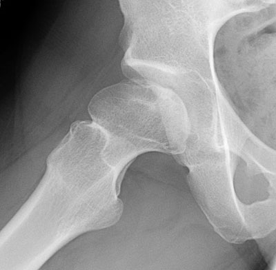 Legg-Calve-Perthes_Disease (5).jpg